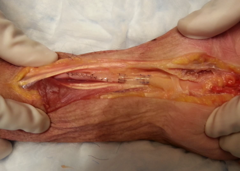 進(jìn)口外周神經(jīng)導(dǎo)管