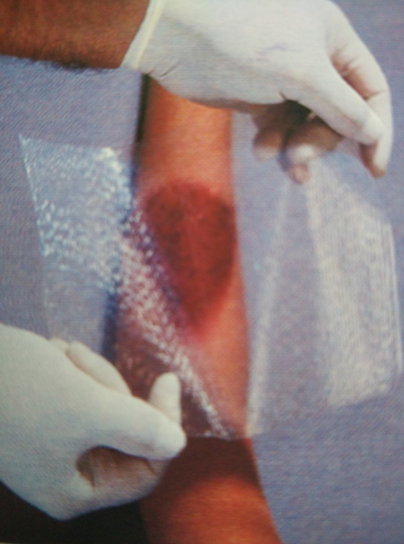 美國進口歐密得燒傷科人工皮膜