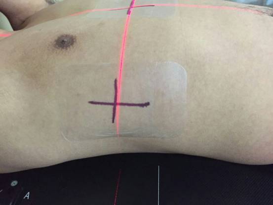 放療定位標記線保護膜