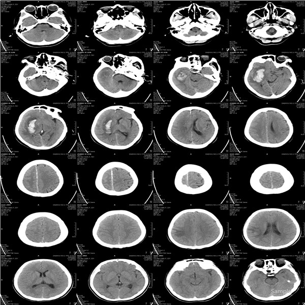 A3瓷白醫(yī)用膠片彩色激光打印膠片 醫(yī)療A3激光打印膠片