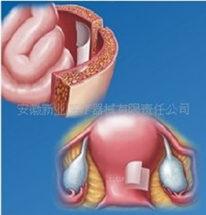 可吸收醫(yī)用膜（成都迪康）