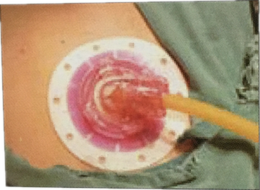 【瑞定】引流導(dǎo)管固定器