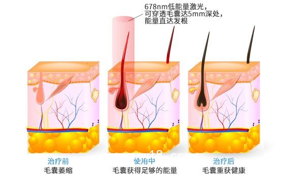 “艾博拉”半導(dǎo)體激光生發(fā)儀、全國招商代理、加盟