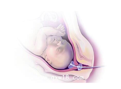 維力醫(yī)療的一次性使用子宮頸擴張球囊導管