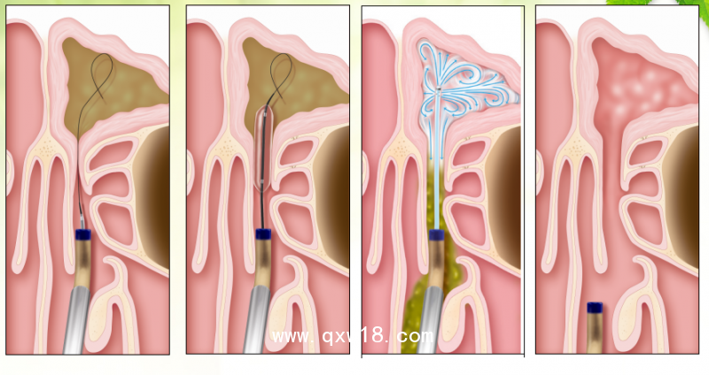 鼻竇球囊導(dǎo)管