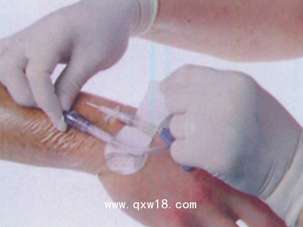 醫(yī)用導管夾 導管固定帖（置留針固定） A型中