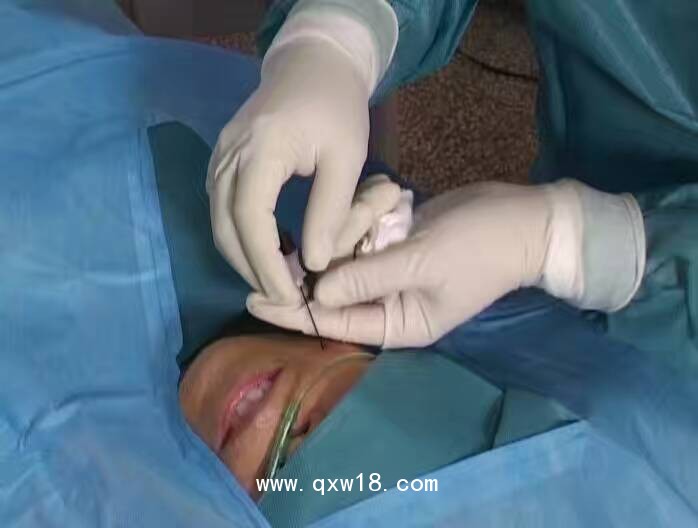 射頻熱凝器 北琪射頻 疼痛治療儀