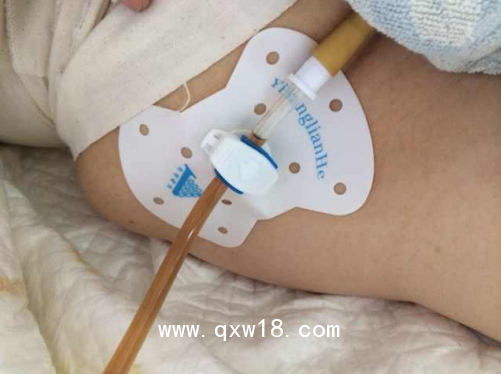 亦康聯(lián)合醫(yī)用導管固定敷料