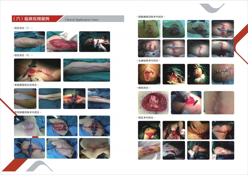 拉桿式傷口皮膚擴展器