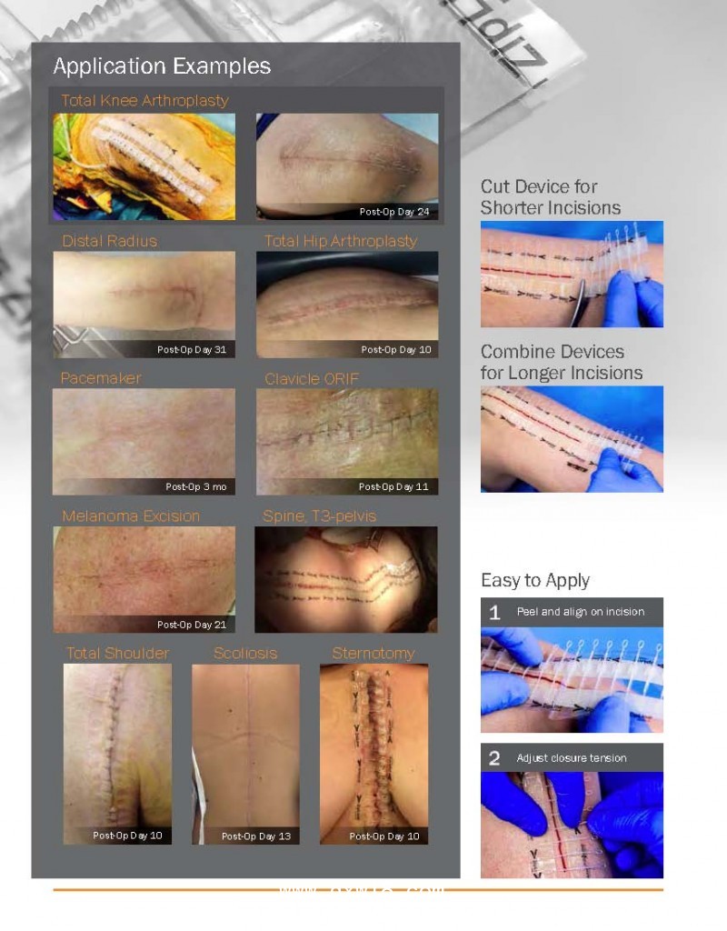 捷膚聯(lián)無(wú)創(chuàng)高強(qiáng)度皮膚縫合器