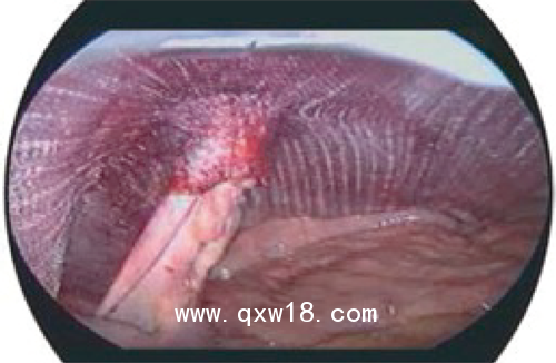 德國(guó)PVDF材質(zhì)疝氣補(bǔ)片-IPST