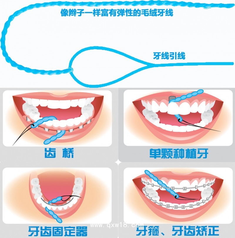 愛得齒正畸種植專用牙線