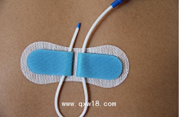 一次性導(dǎo)管固定裝置（留置針延長管、硬膜外固定裝置）