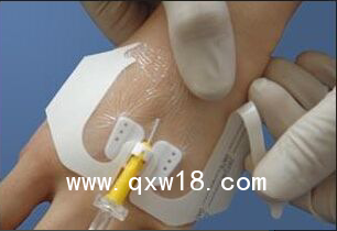 體表導管固定裝置