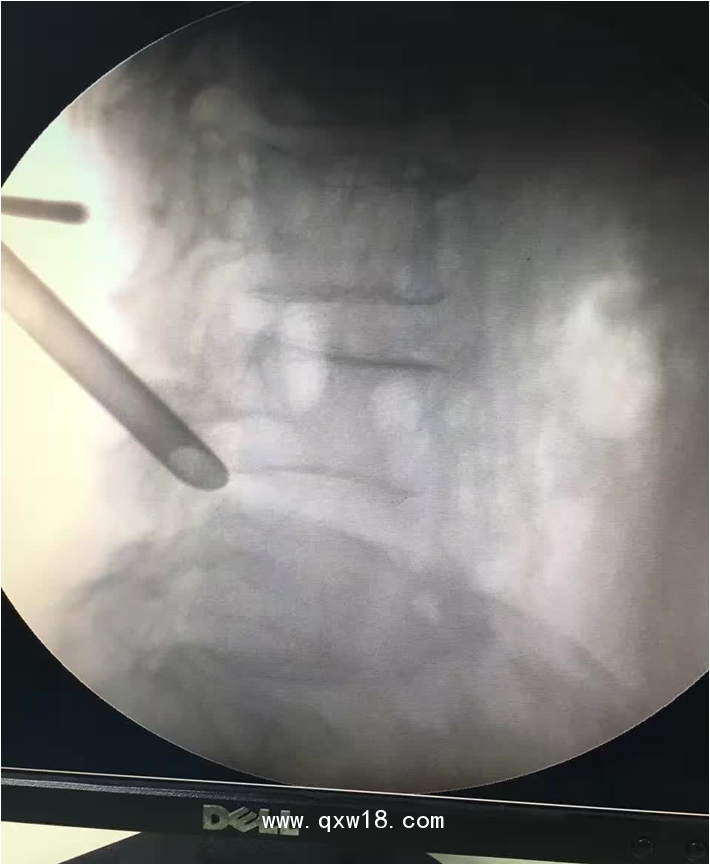 椎間孔鏡品牌椎間孔鏡椎間孔鏡技術椎間孔鏡培訓