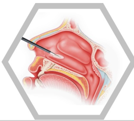 等離子手術刀頭VAM-3040340椎間孔鏡手術射頻電極