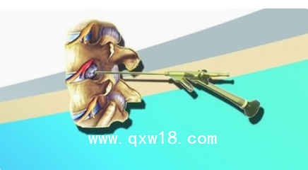 德國ASAP脊柱內(nèi)窺鏡及手術(shù)器械