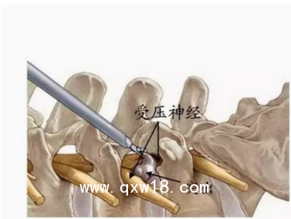 德國ASAP脊柱內(nèi)窺鏡及手術(shù)器械