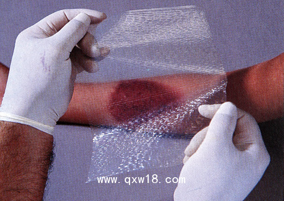 美國進口歐密得Omiderm人工皮膜 傷口敷料