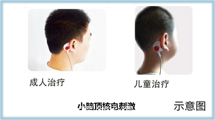 美迪泰 腦循環(huán)功能障礙治療儀 腦循環(huán)功能治療儀