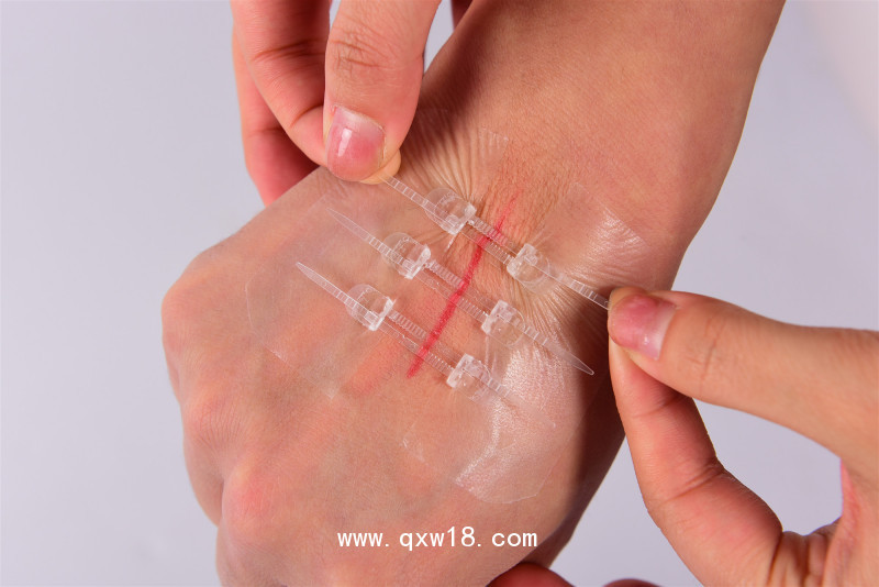 彈性綁帶（減張拉合）