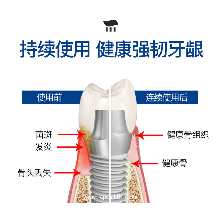 國(guó)內(nèi)首支鈦舒鎂種植牙專用護(hù)理牙膏