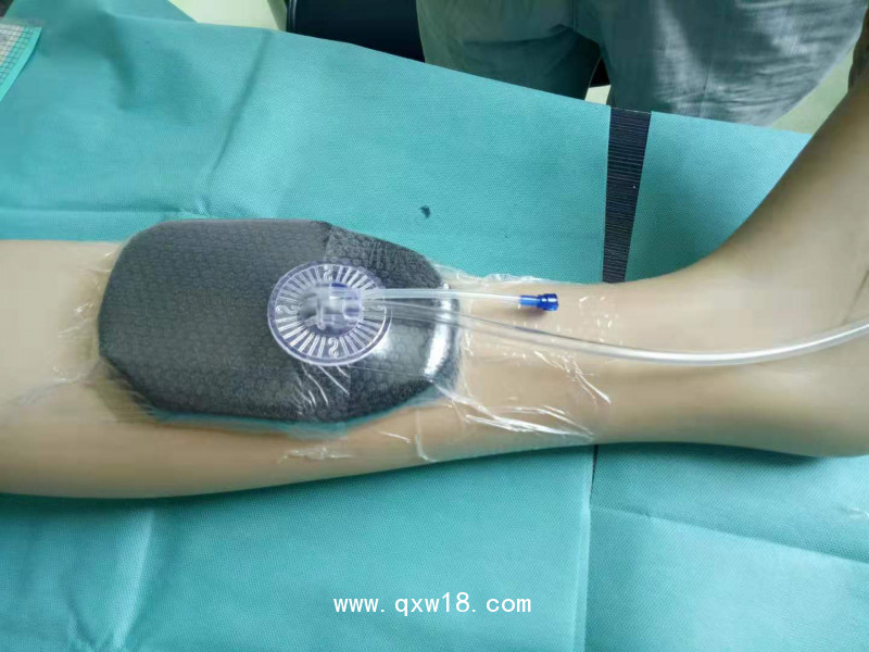 一次性負壓引流護創(chuàng)材料 獨立吸盤式