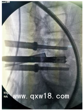 UBE器械、UBE技術(shù)