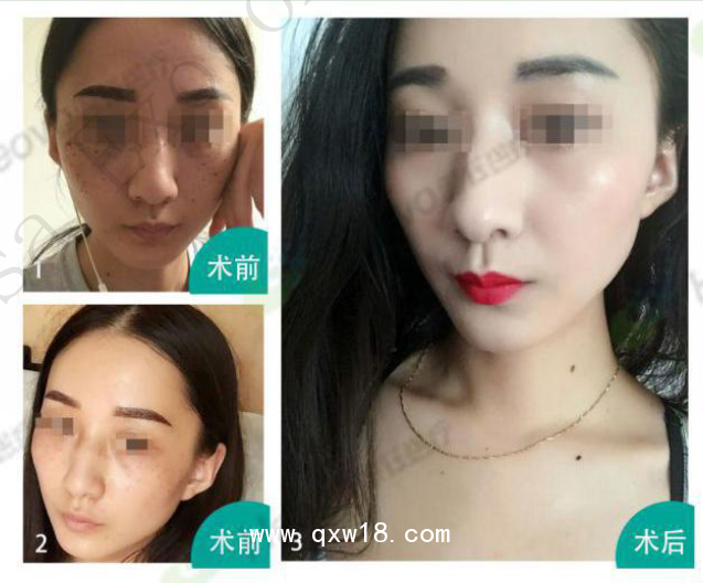 美拉美尚干細(xì)胞外泌體液體敷料