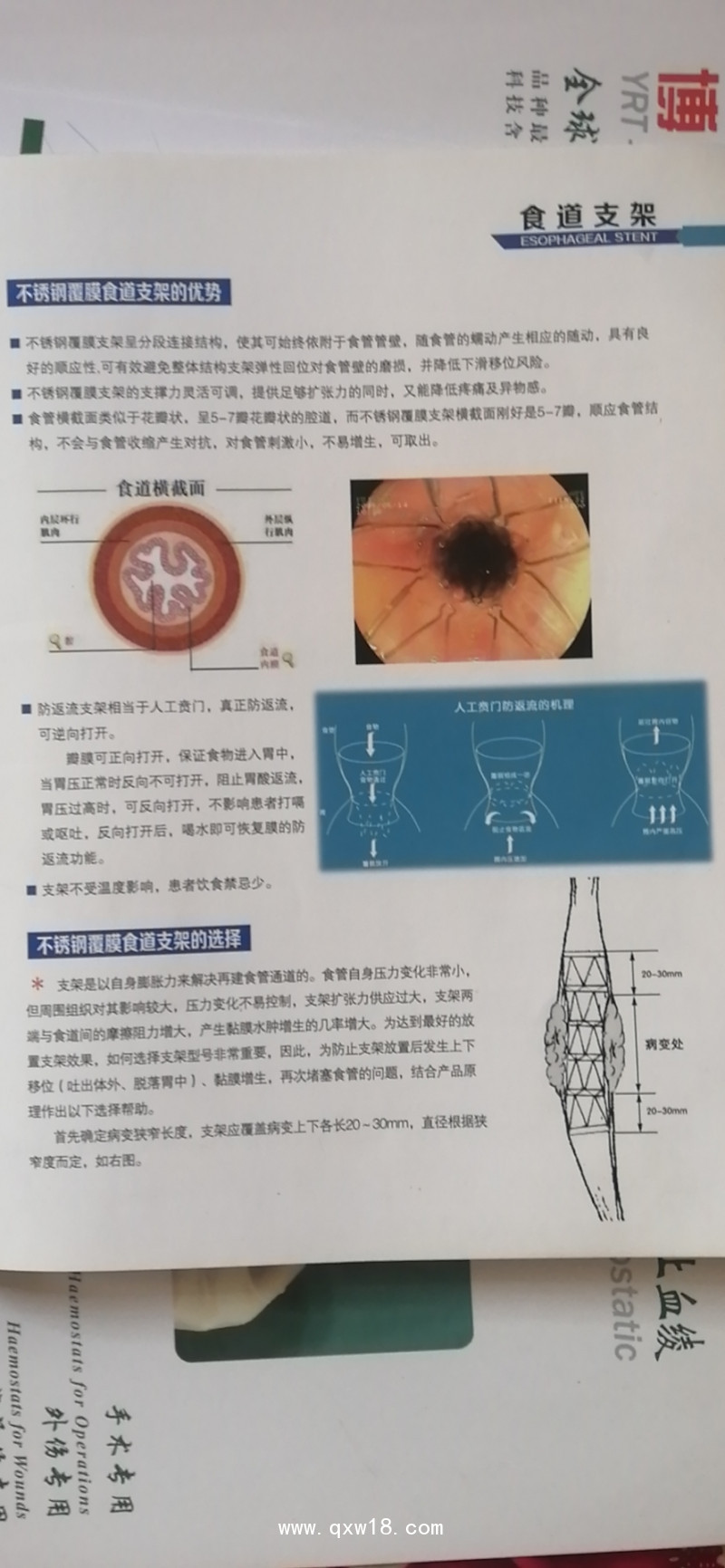 不銹鋼/食道支架/腹膜食道支架