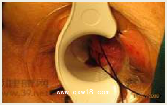 縫扎用肛門(mén)鏡