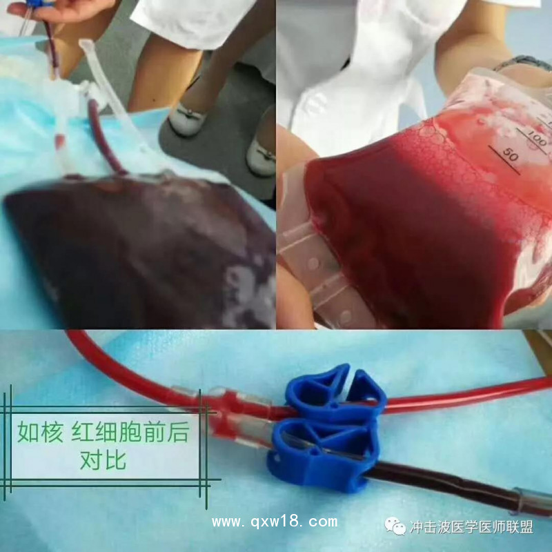 臭氧自體血血袋、三氧自體血血袋、一次性血袋