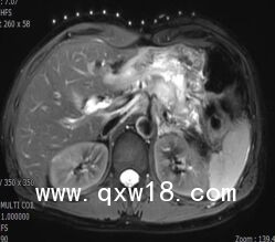 醫(yī)學(xué)圖像體外定位貼（MK#MR型，MR引導(dǎo)定位柵）