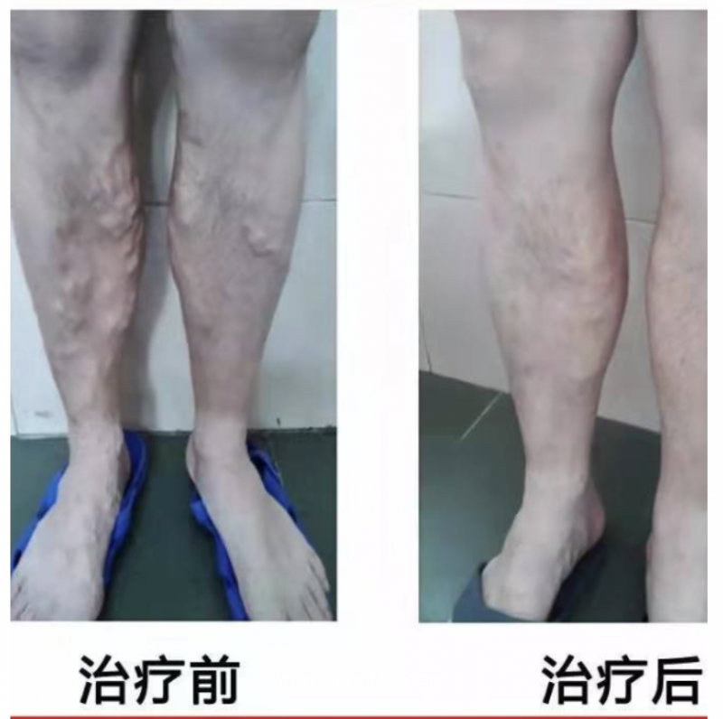 一次性微波消融導管 德文