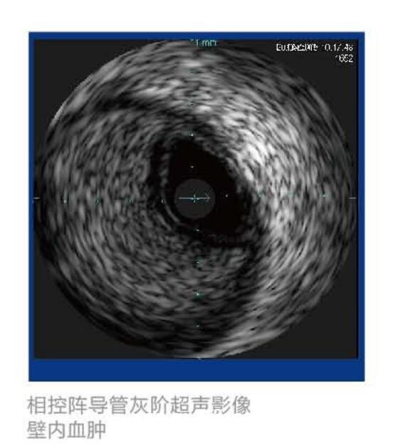 美國VOLCANO血管內(nèi)超聲波診斷儀 S5