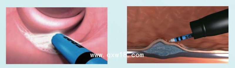 愛爾博 氬氣刀 VIO200D