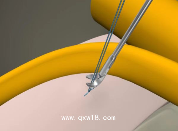 一次性纖維環(huán)縫合器廠家 浙江歸創(chuàng)