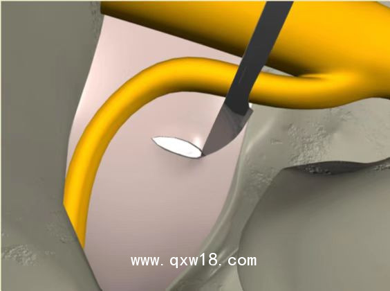 一次性纖維環(huán)縫合器使用意義 優(yōu)劣勢(shì)