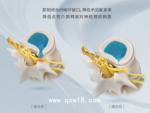 脊柱科骨科非帶量高值耗材一次性纖維環(huán)縫合器