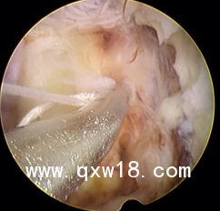 國(guó)產(chǎn)高值耗材非帶量纖維環(huán)縫合器生產(chǎn)廠家