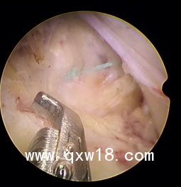 纖維環(huán)縫合器圖片及操作視頻