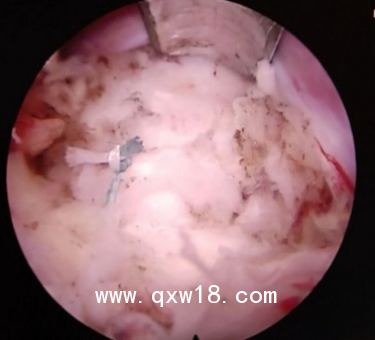 纖維環(huán)縫合器