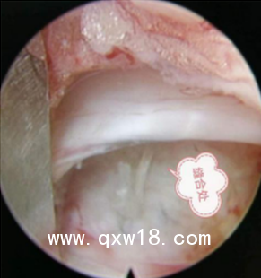 一次性纖維環(huán)縫合器SK48095A