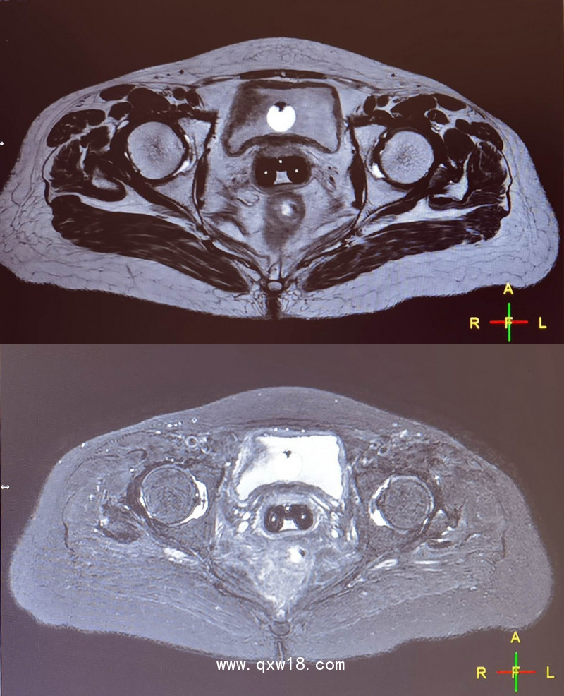 三維后裝CT/MR施源器MR成像標(biāo)記線（醫(yī)學(xué)圖像標(biāo)記定位貼）