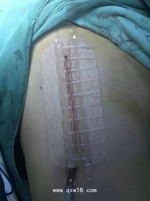 佳痕醫(yī)用免縫拉扣（可調(diào)式無(wú)針無(wú)創(chuàng)皮膚縫合器）