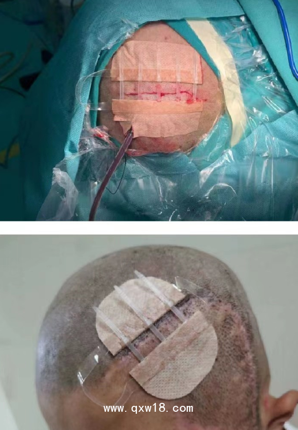 佳痕醫(yī)用免縫拉扣（可調(diào)式無(wú)針無(wú)創(chuàng)皮膚縫合器）