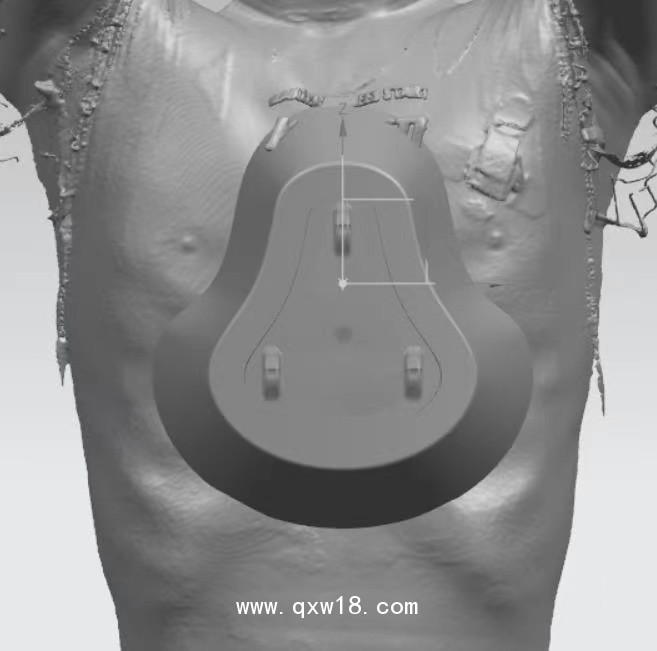 漏斗胸矯正器，負壓吸盤