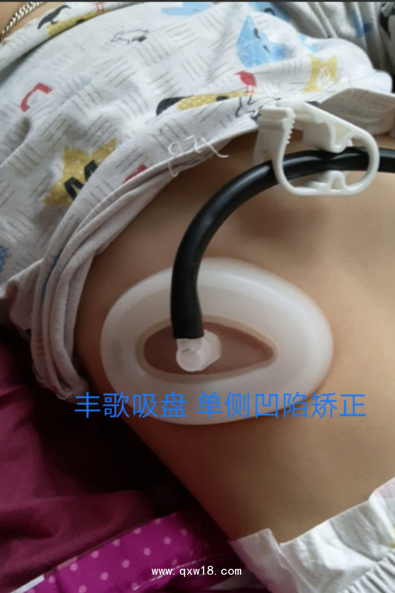 漏斗胸矯正器，負壓吸盤