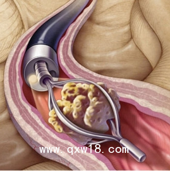 激光治療機 JRHI鈥激光 泌尿系統(tǒng)結石粉碎機 普美康