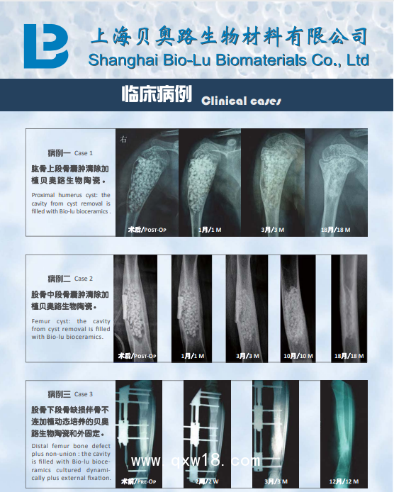 國產貝奧路多孔生物陶瓷 骨科 骨缺損 脊柱融合 骨腫瘤 骨不連 關節(jié)融合